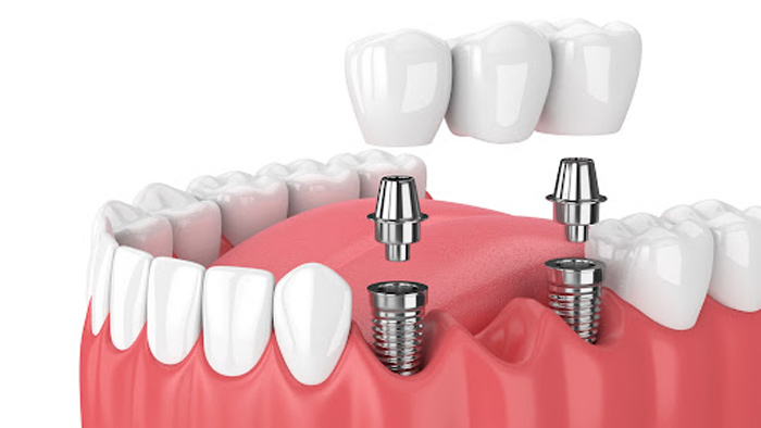 Dental Implant Dentists Grandville Mi