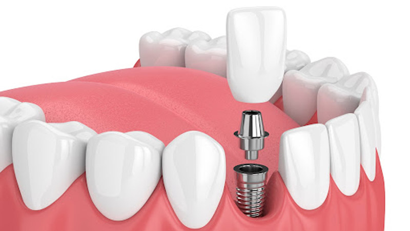 Dental Implants Dentist Grandville Mi