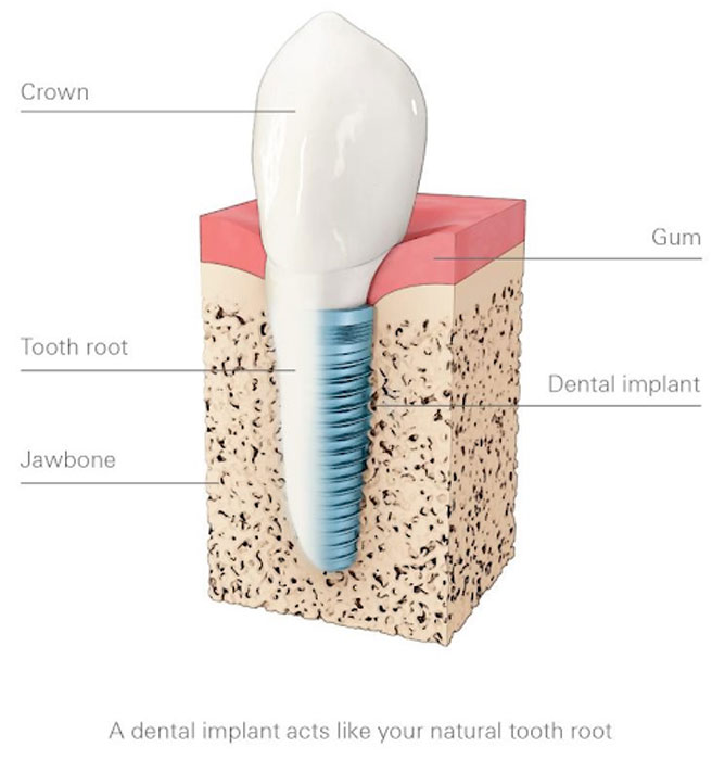 Dental Implants Grandville Mi Dentist