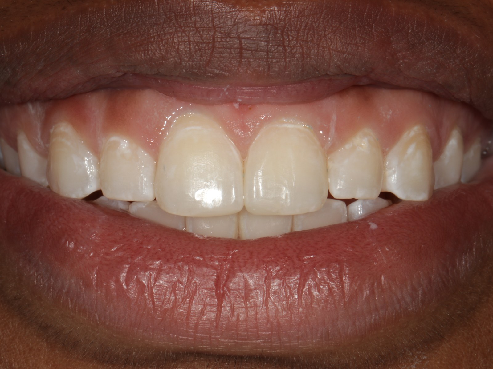 After treatment - Bonding to restore worn incisal edges