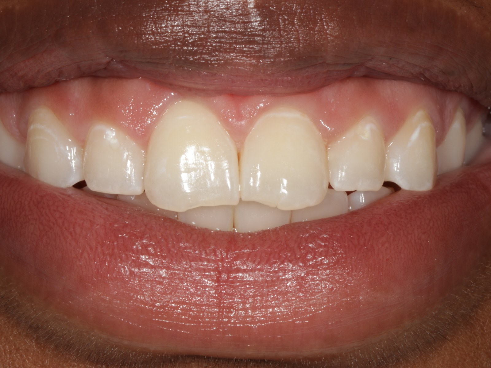 Before treatment - Bonding to restore worn incisal edges