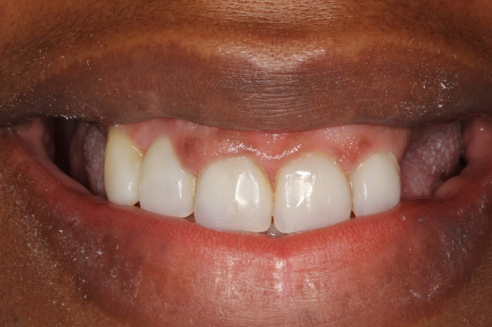 After treatment - Bonding to restore badly decayed teeth