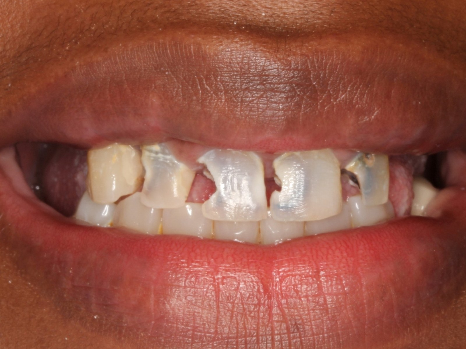 Before treatment - Bonding to restore badly decayed teeth