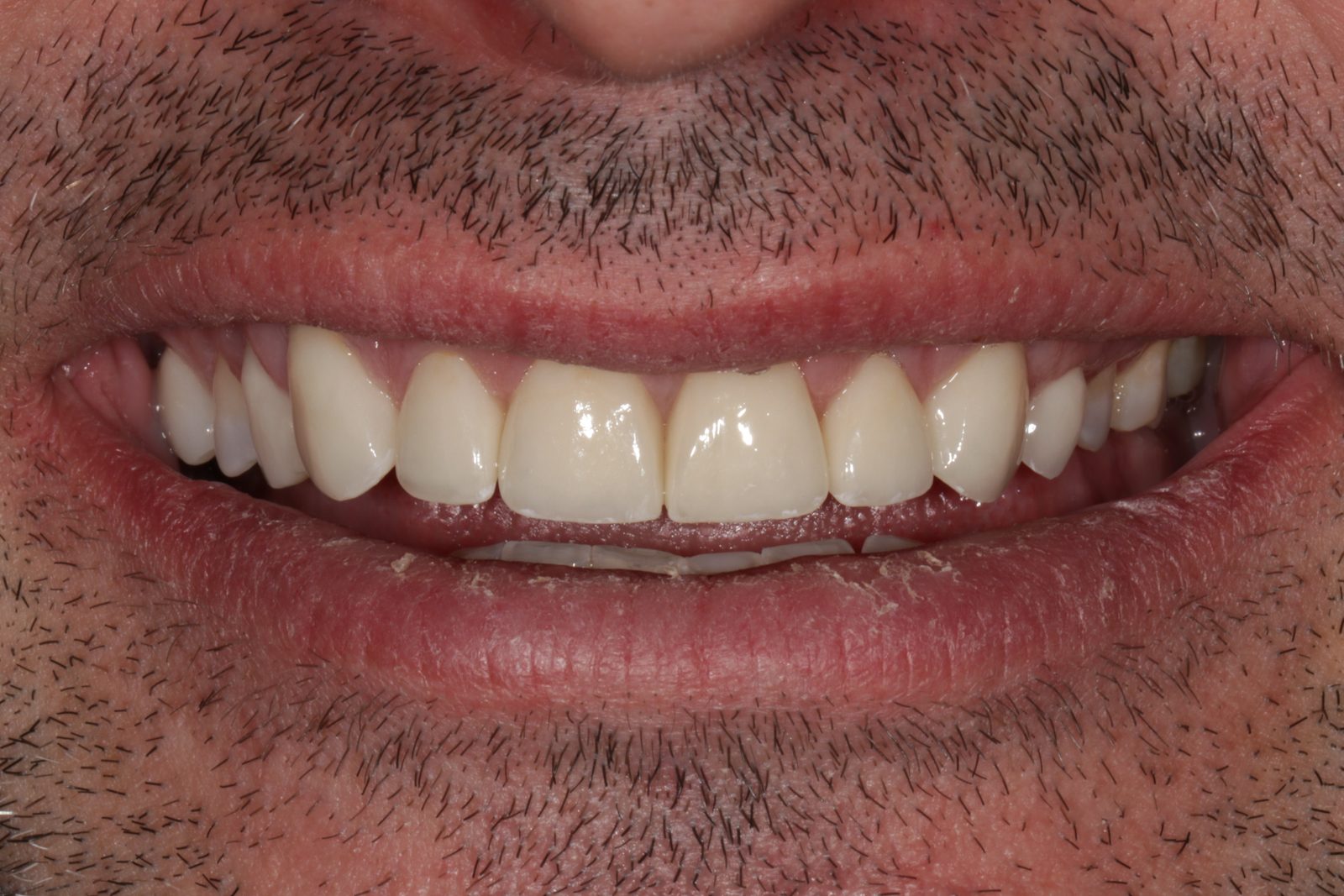After treatment - Crowns to restore tooth shape and enhance esthetics