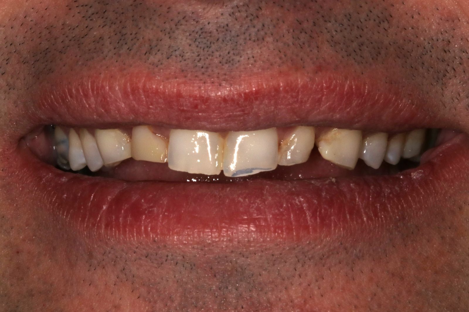 Before treatment - Crowns to restore tooth shape and enhance esthetics