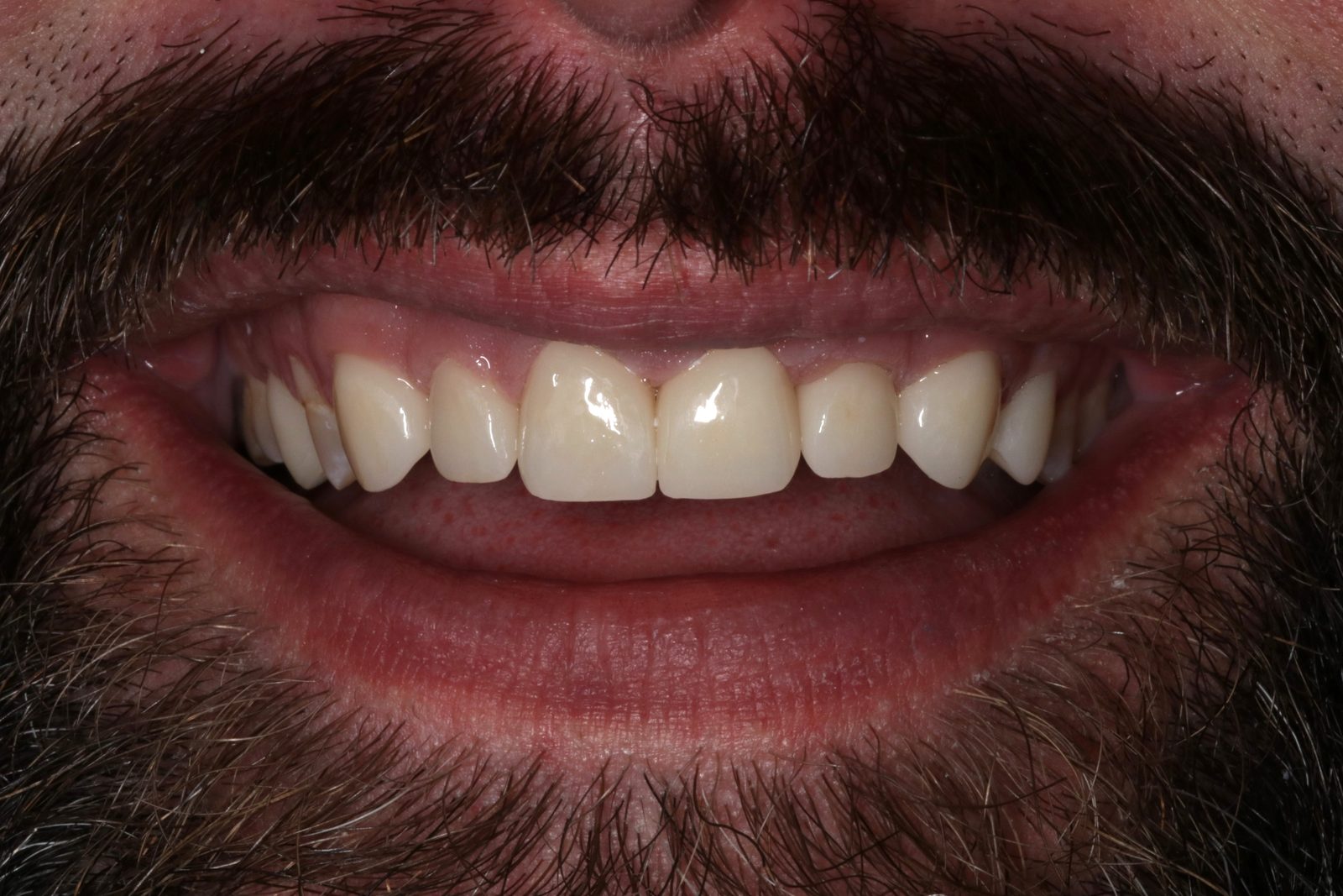 After treatment - Crowns to restore badly decayed teeth