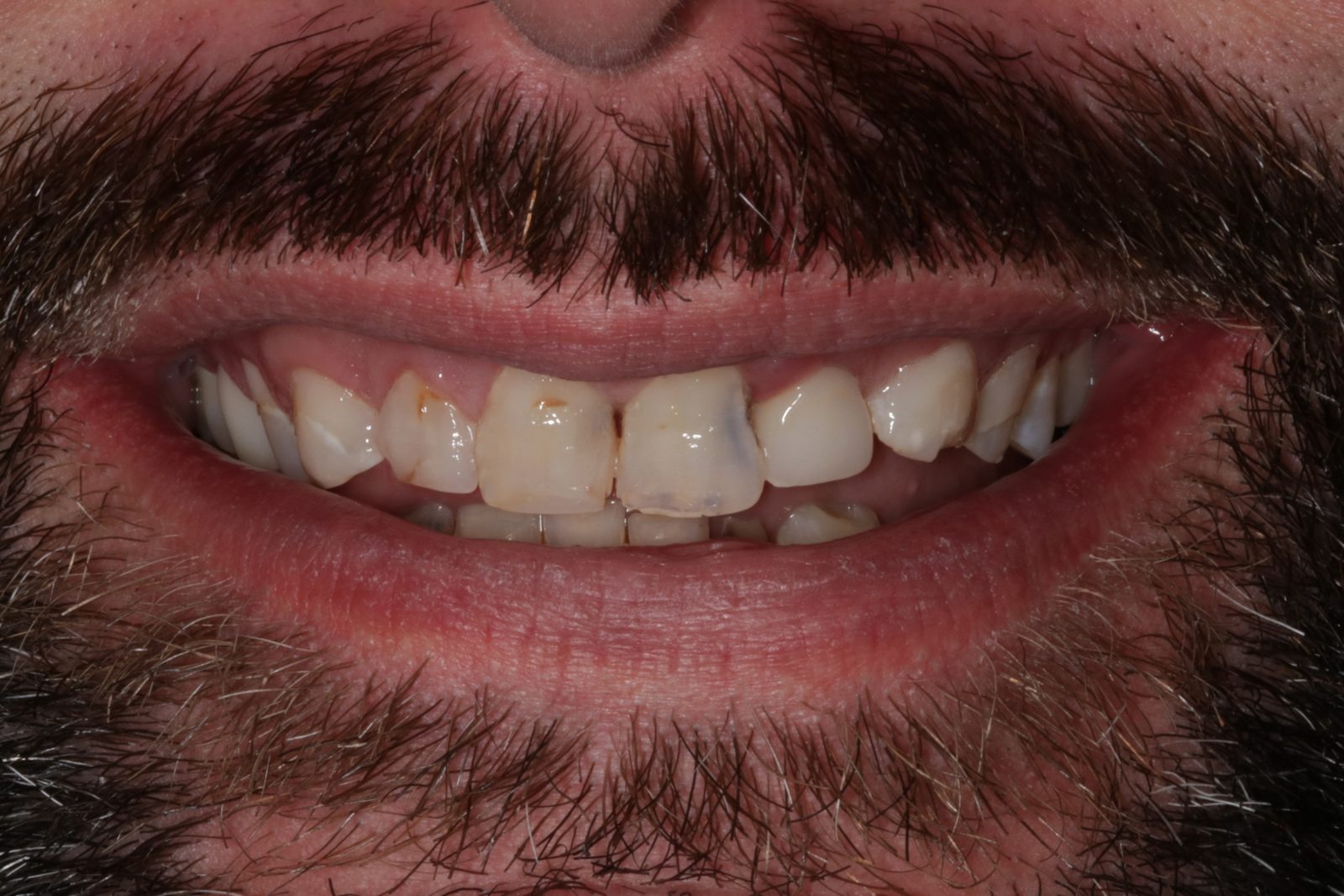 Before treatment - Crowns to restore badly decayed teeth