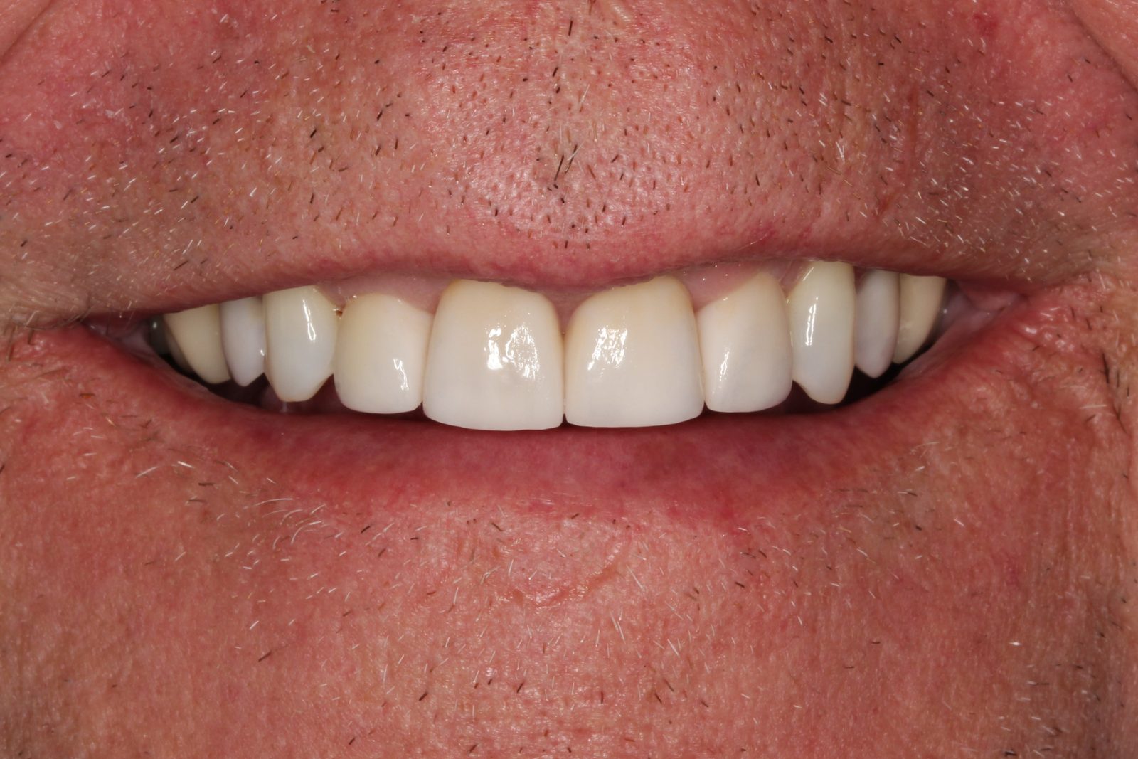After treatment - Crowns to restore fractured teeth and enhance esthetics