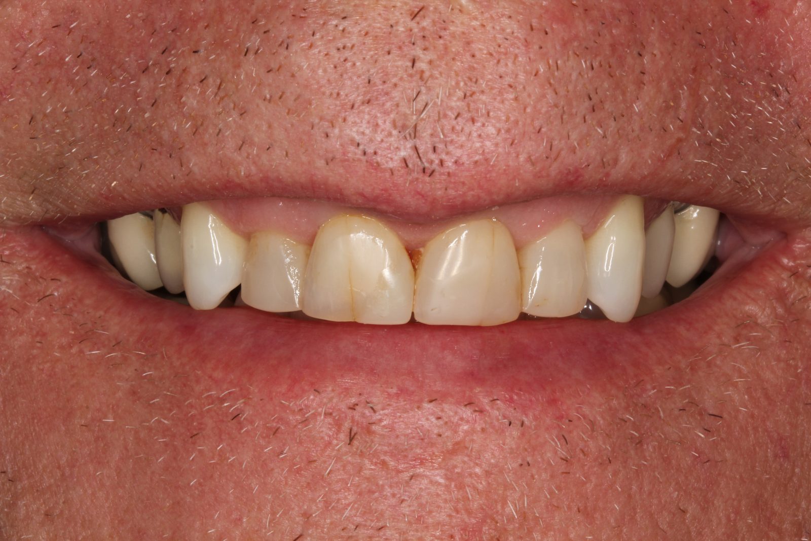 Before treatment - Crowns to restore fractured teeth and enhance esthetics