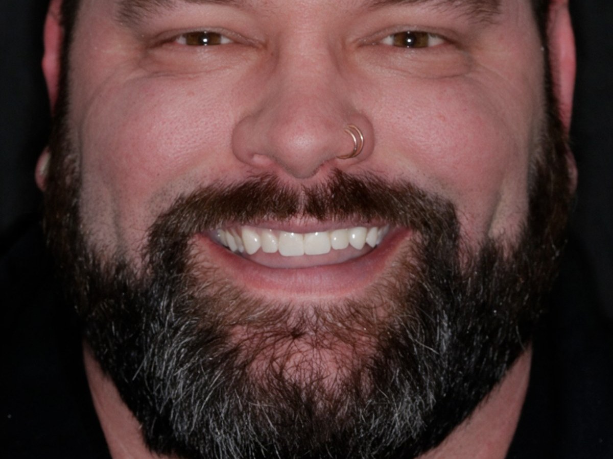 After treatment - Crowns to restore badly decayed teeth