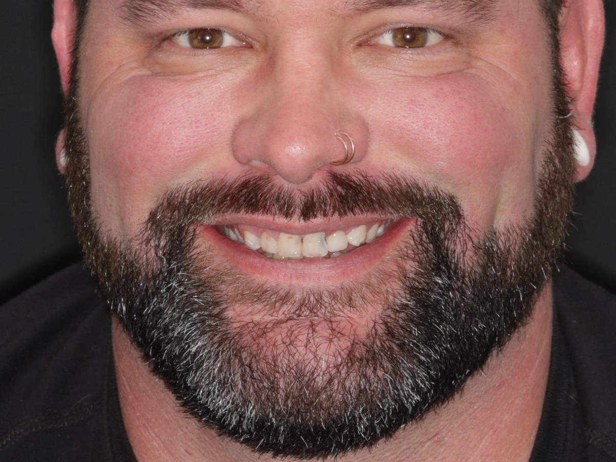 Before treatment - Crowns to restore badly decayed teeth