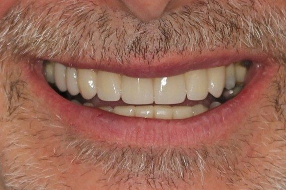 After treatment - Crowns to restore tooth shape and enhance esthetics
