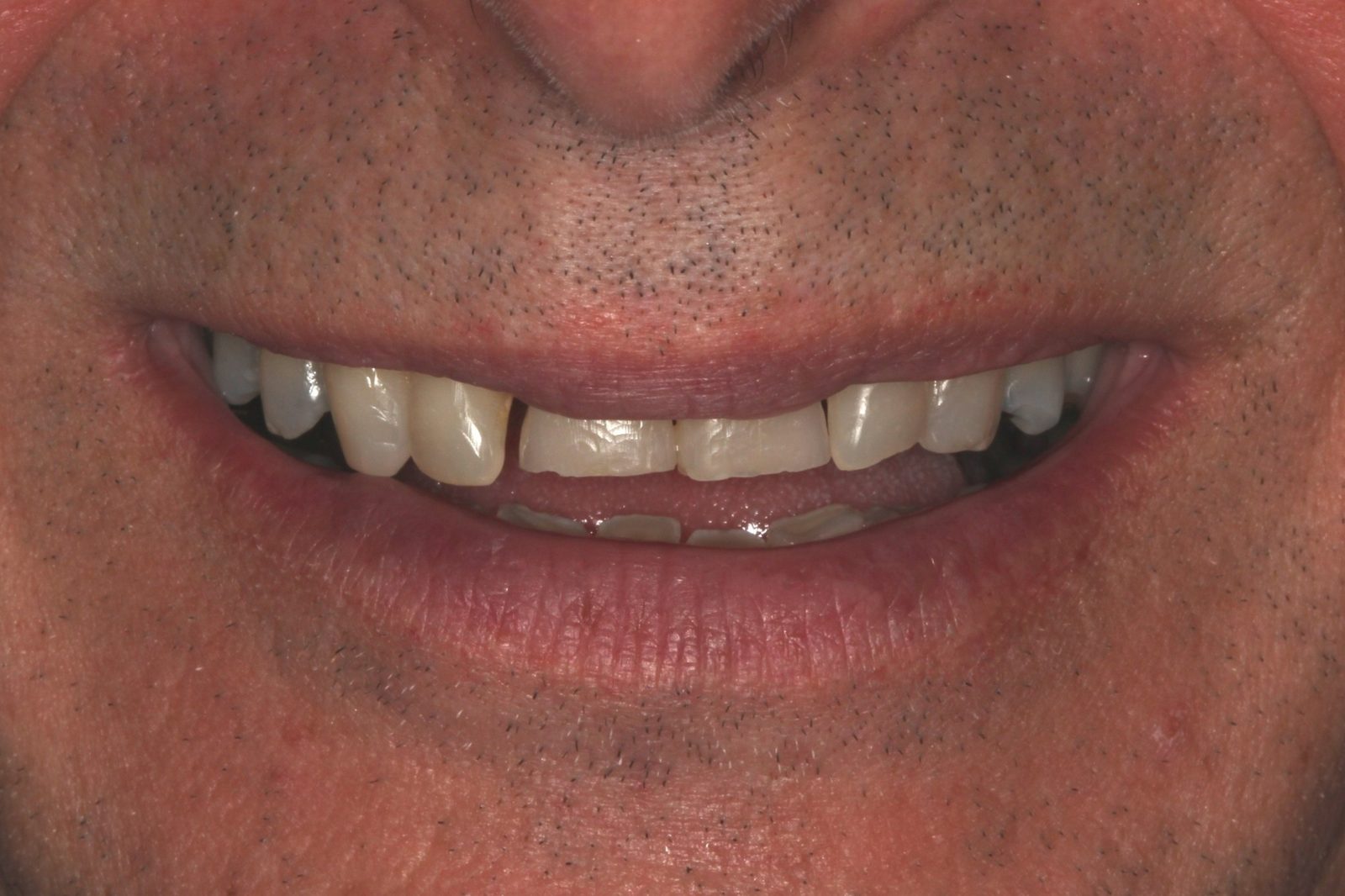 Before treatment - Crowns to restore tooth shape and enhance esthetics