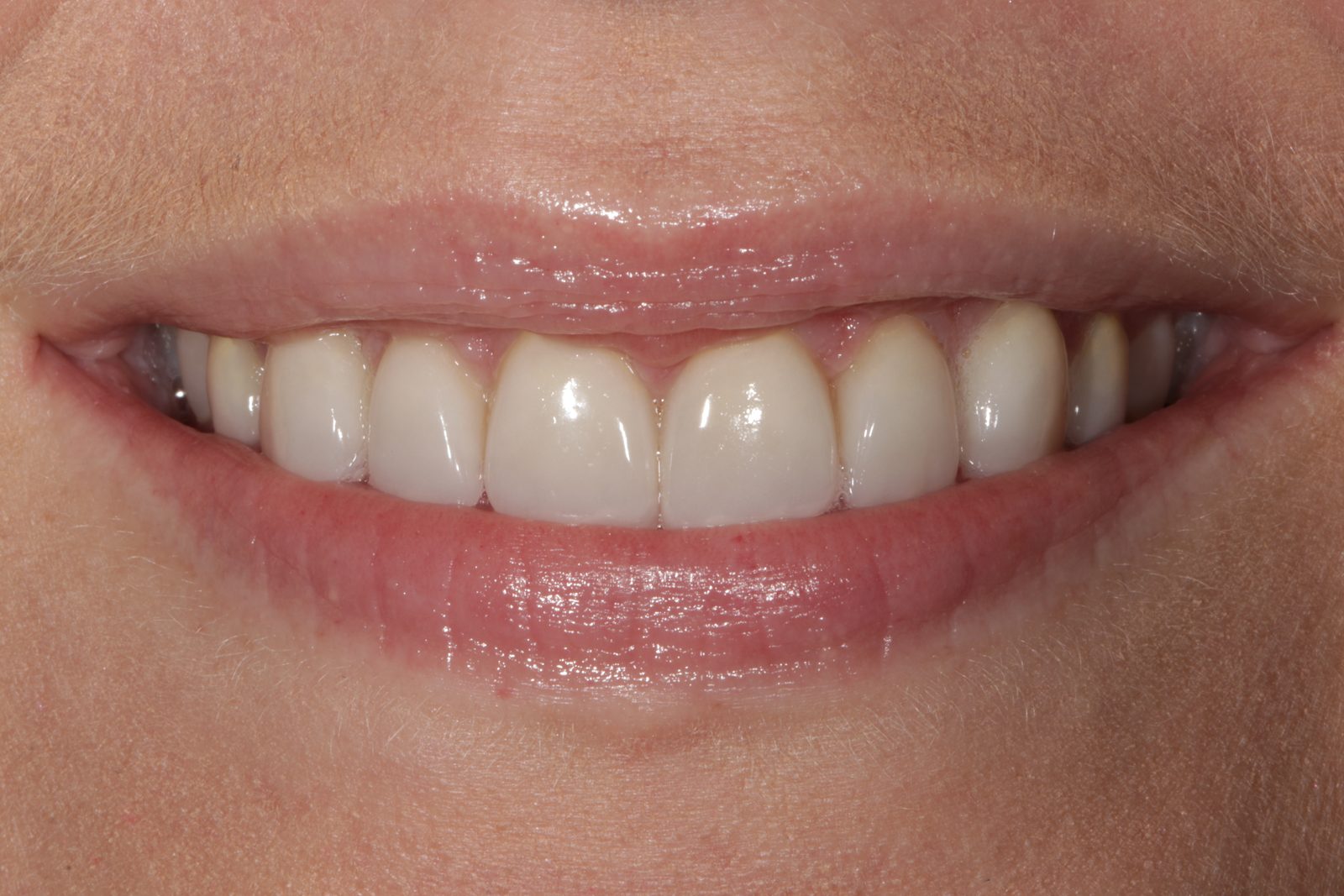 After treatment - Veneers to close spacing and correct tooth shape