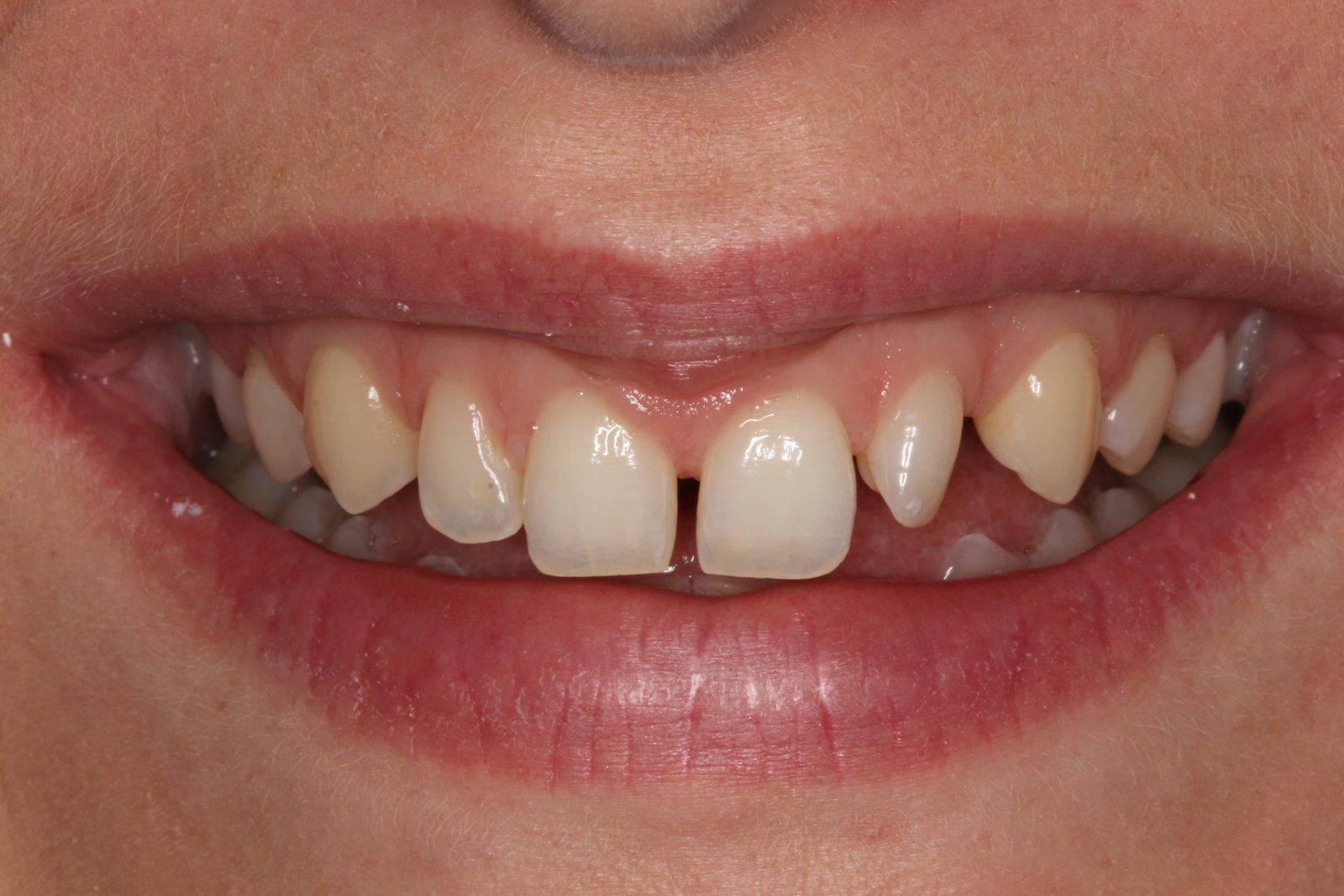 Before treatment - Veneers to close spacing and correct tooth shape