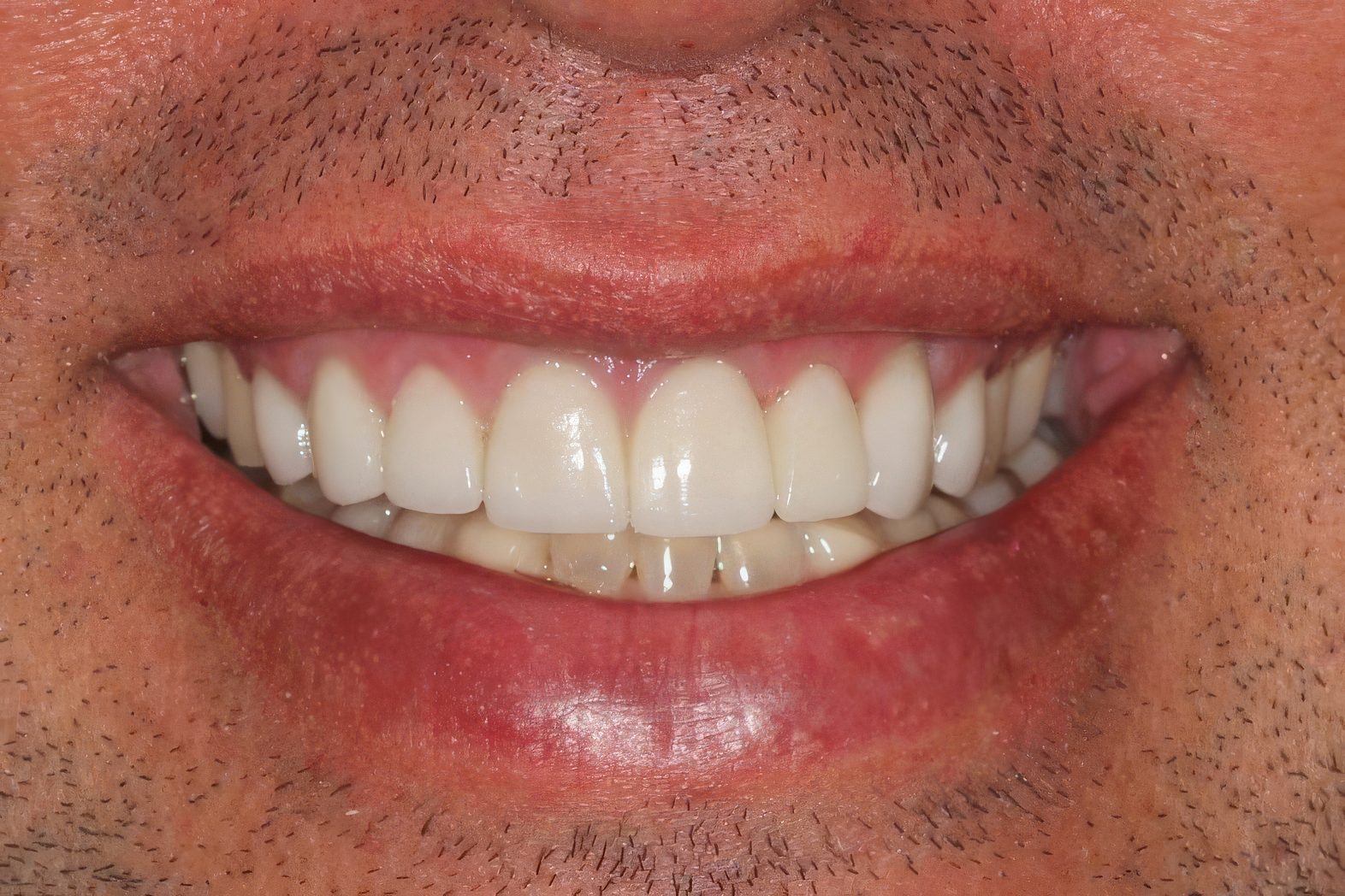 After treatment - Crowns/veneers to close spacing and correct tooth shape