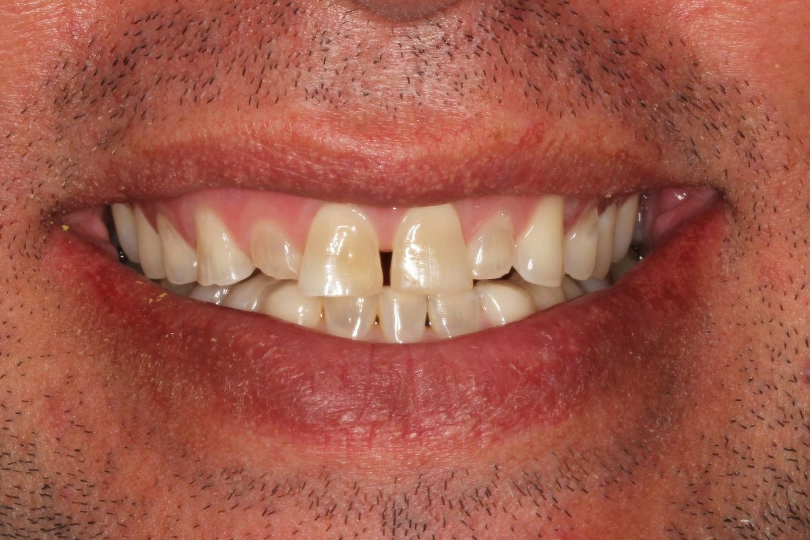 Before treatment - Crowns/veneers to close spacing and correct tooth shape
