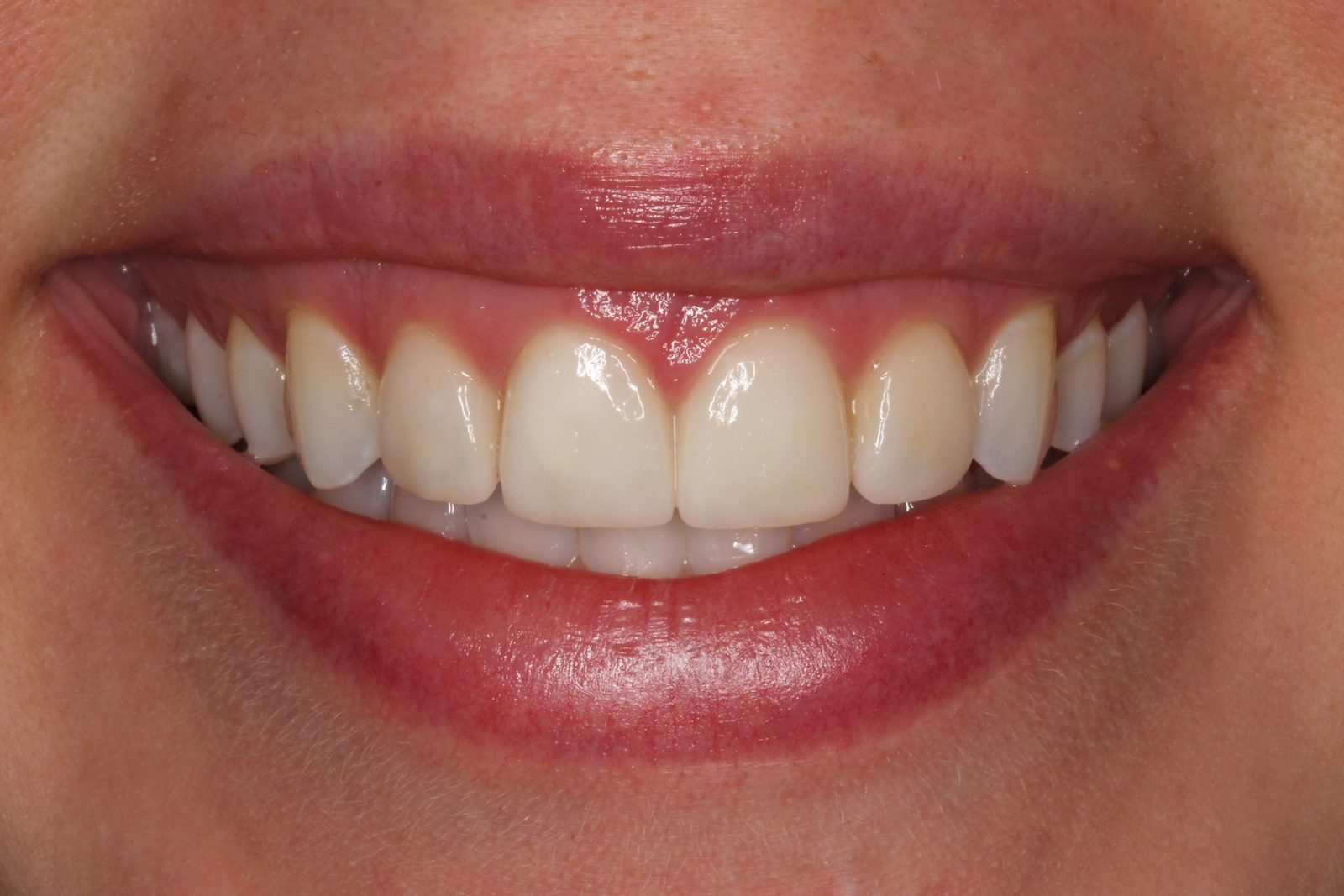 After treatment - Veneers to replace failing old fillings