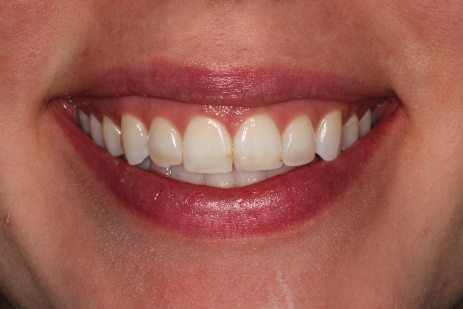Before treatment - Veneers to replace failing old fillings