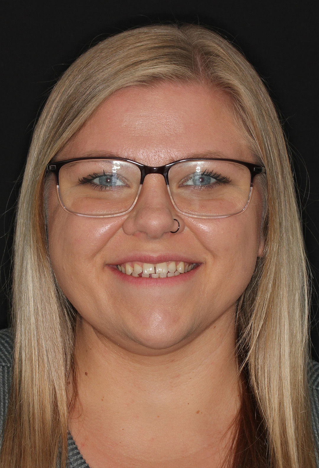 Before treatment - Clear Aligners & Veneers