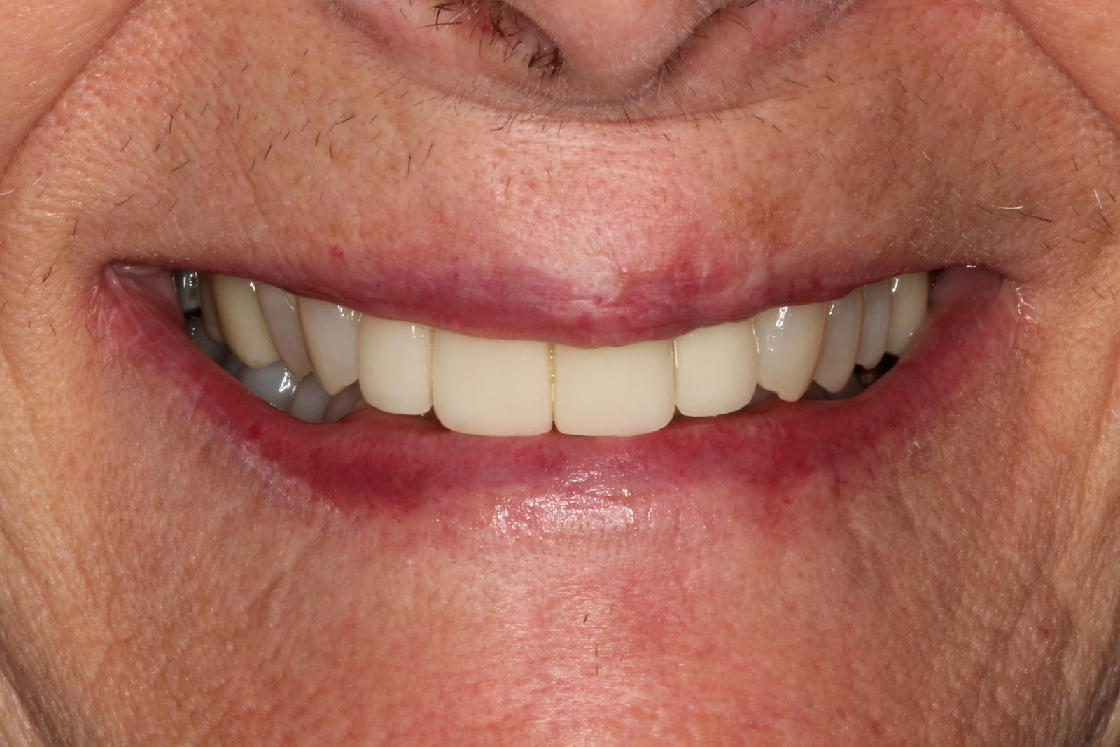 After treatment - Full mouth rehab utilising implants to restore decay, wear and missing teeth