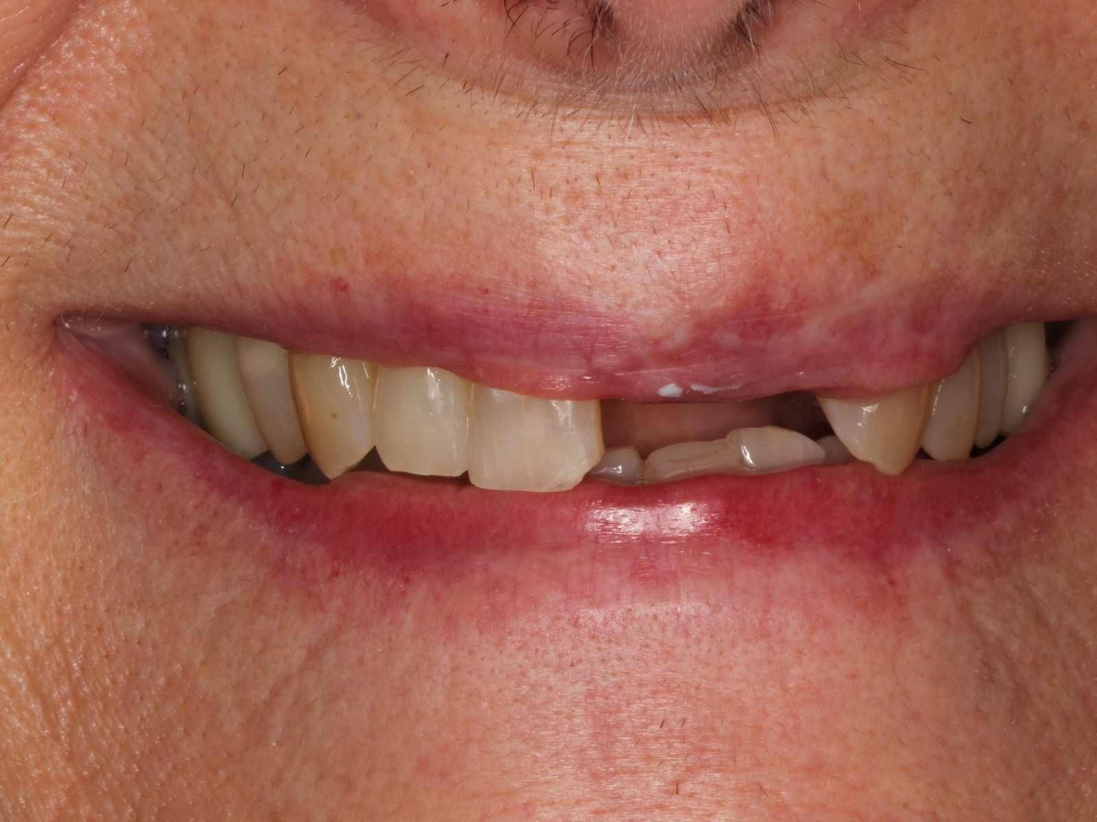 Before treatment - Full mouth rehab utilising implants to restore decay, wear and missing teeth