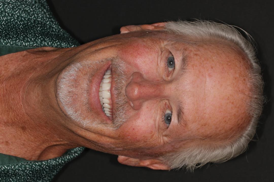 After treatment - Upper All-On-X Implants
