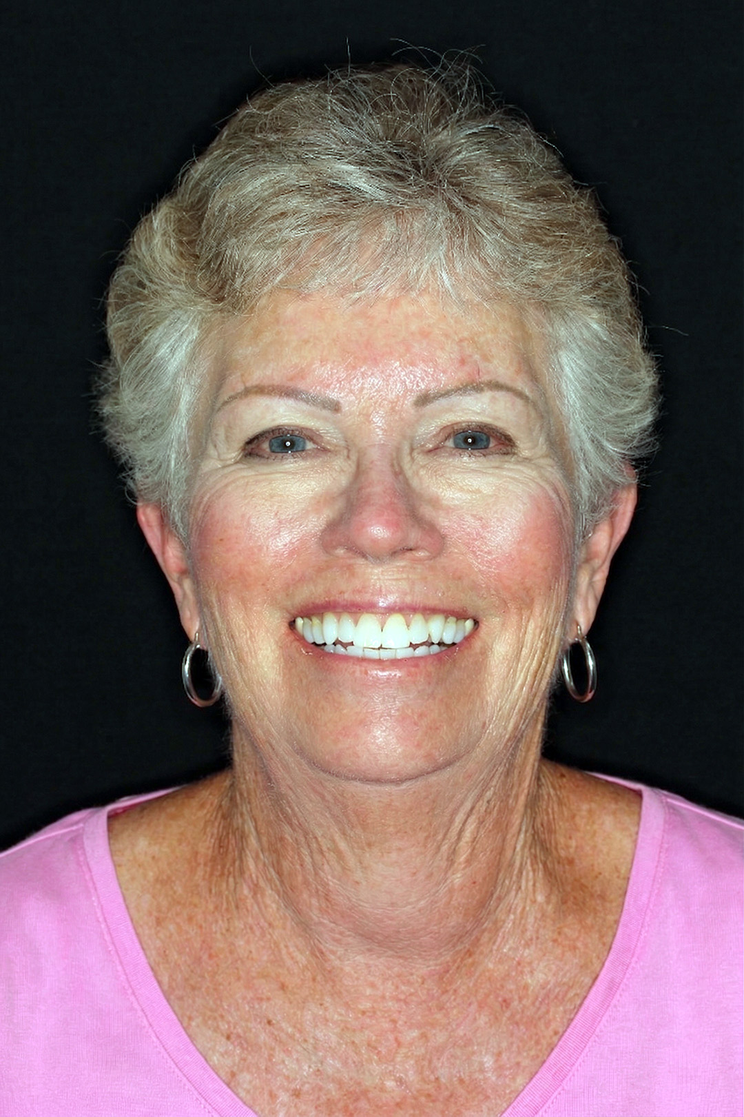 After treatment - Aligners — 9 Year Follow Up